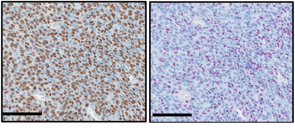 Photo: Cells from a bone cancer caused by a histone mutation are brown if they contain the mutation (left). Purple cells are intact, without the mutation (right). 