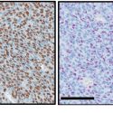 Photo: Cells from a bone cancer caused by a histone mutation are brown if they contain the mutation (left). Purple cells are intact, without the mutation (right).