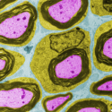 Photo: Supportive Schwann cells (green) surround the conductive axon (purple) of a neuron in the peripheral nervous system in this artificially colored image. A new study by John Svaren of the University of Wisconsin-Madison shows that Schwann cells not only make the insulating myelin (black), but also are active players in axon repair after damage.