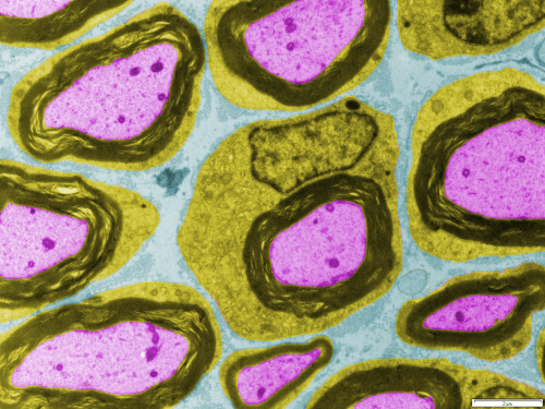 Photo: Supportive Schwann cells (green) surround the conductive axon (purple) of a neuron in the peripheral nervous system in this artificially colored image. A new study by John Svaren of the University of Wisconsin–Madison shows that Schwann cells not only make the insulating myelin (black), but also are active players in axon repair after damage.