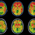 One project funded by the new initiative will explore how microorganisms in the human gut may influence Alzheimer's disease through plaques and tangles, shown here in brain images.