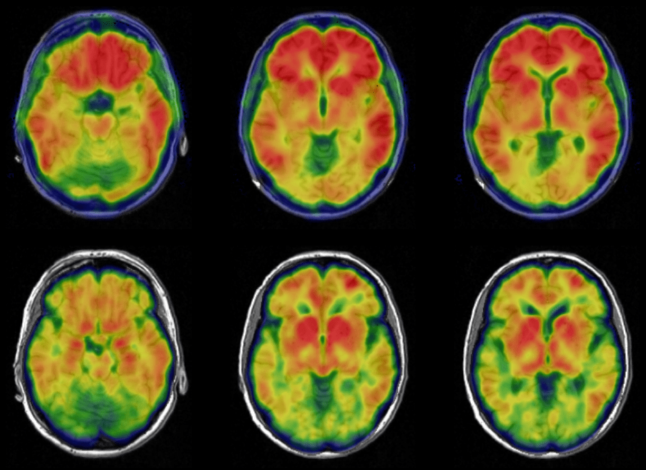 One project funded by the new initiative will explore how microorganisms in the human gut may influence Alzheimer's disease through plaques and tangles, shown here in brain images.