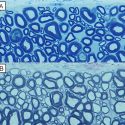 The normal mature dog spinal cord (A) has many axons surrounded by thick myelin sheaths (blue).  In contrast, in the recovered dog with the genetic abnormality (B), there are many axons with thin myelin sheaths, identical to that seen in remyelination.
