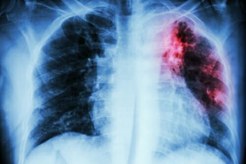 Photo: X-ray of lungs infected with TB