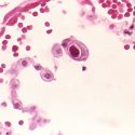 The central cell shows the dramatically enlarged nuclei characteristic of cytomegalovirus in the lung. 
