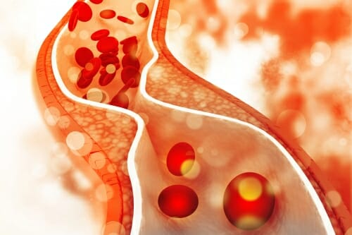 Illustration: Cross-section of plaque in an artery