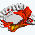 An image of the brain from the Wisconsin Alzheimer’s Disease Research Center , which uses cutting edge molecular tau and amyloid imaging and fluid biomarker techniques together with neurobehavioral measurements to study how AD begins and what can be done to prevent i.t