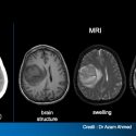 MRI, right, gives much greater detail on a hemorrhagic stroke than CT. Note that brain swelling and the components of the clot are clearly delineated in MRI.  Seeing the clot structure should enable the physician to deliver a clot-busting drug more precisely.