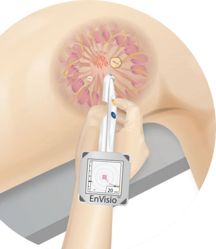 An illustration showing how the Elucent device pinpoints a clip that has been placed inside the patient at a tumor site.