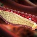 Cross-section diagram of cholesterol with blood cells flowing around it in an artery