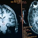 Cross-section images of brain shown on computer monitor