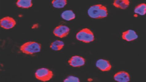 On a black background, lymphoma cells show up in a red and blue polkadot pattern.